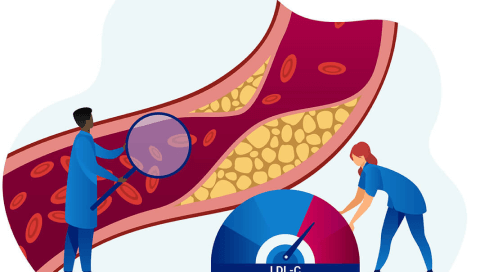 A graphic showing the impact of high LDL-C levels in the wall of a blood vessel.